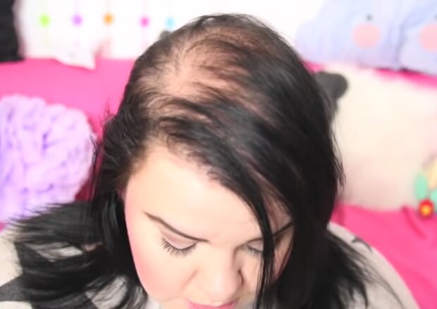 Frau mit schütterem Haar. Quelle: Screenshot Youtube
